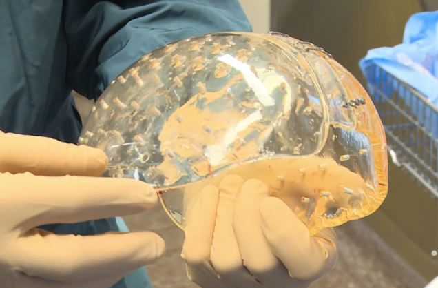 The first transparent 3D-printed skull has just been implanted