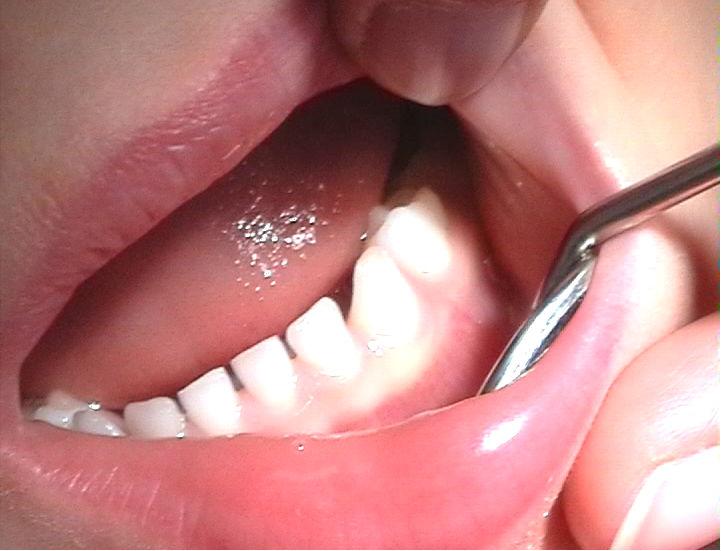 Scientists Regrow Teeth With New Technologies